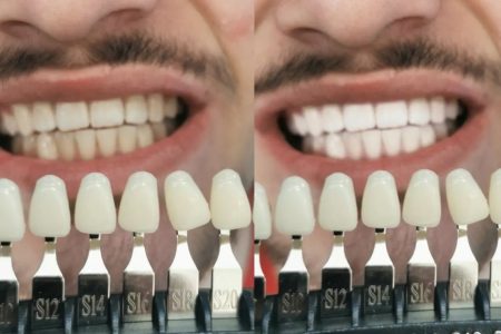 NUR KOSMETIK FREIBURG Zahnbleaching Zähne zahnreinigung weis beaty studio